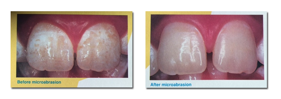 The Pediatric Dentists - Teeth Before After